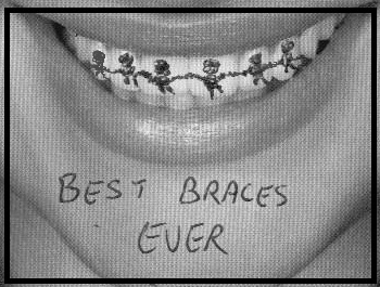best braces ever